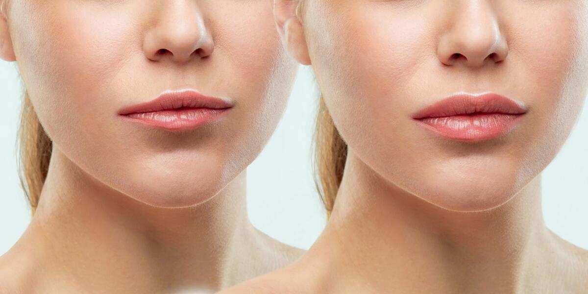 Fillers Treatments in Javea – Restore your Skin & Volume