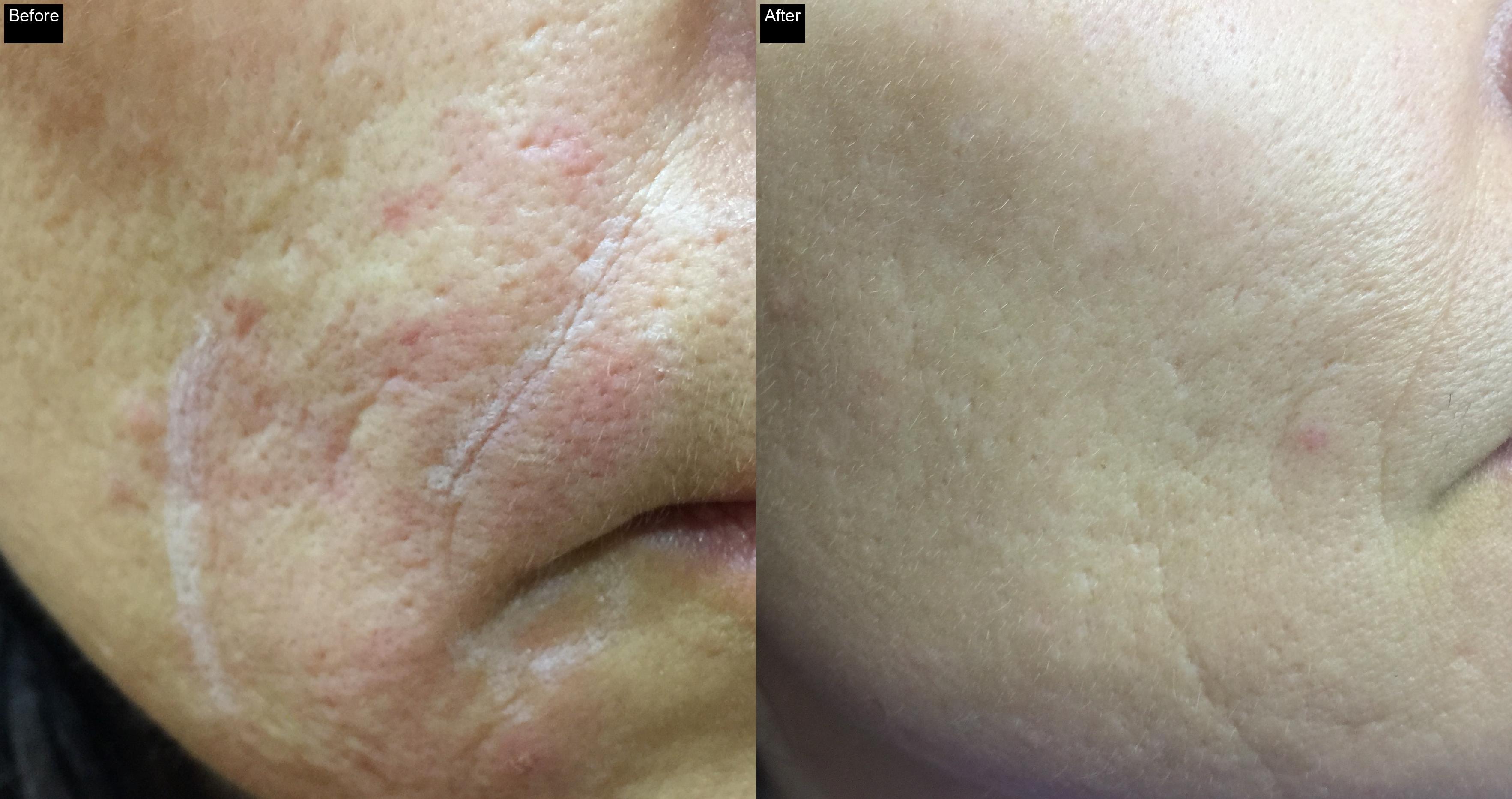 Before / After : Acne Scar Removal with IPL in Javea -1