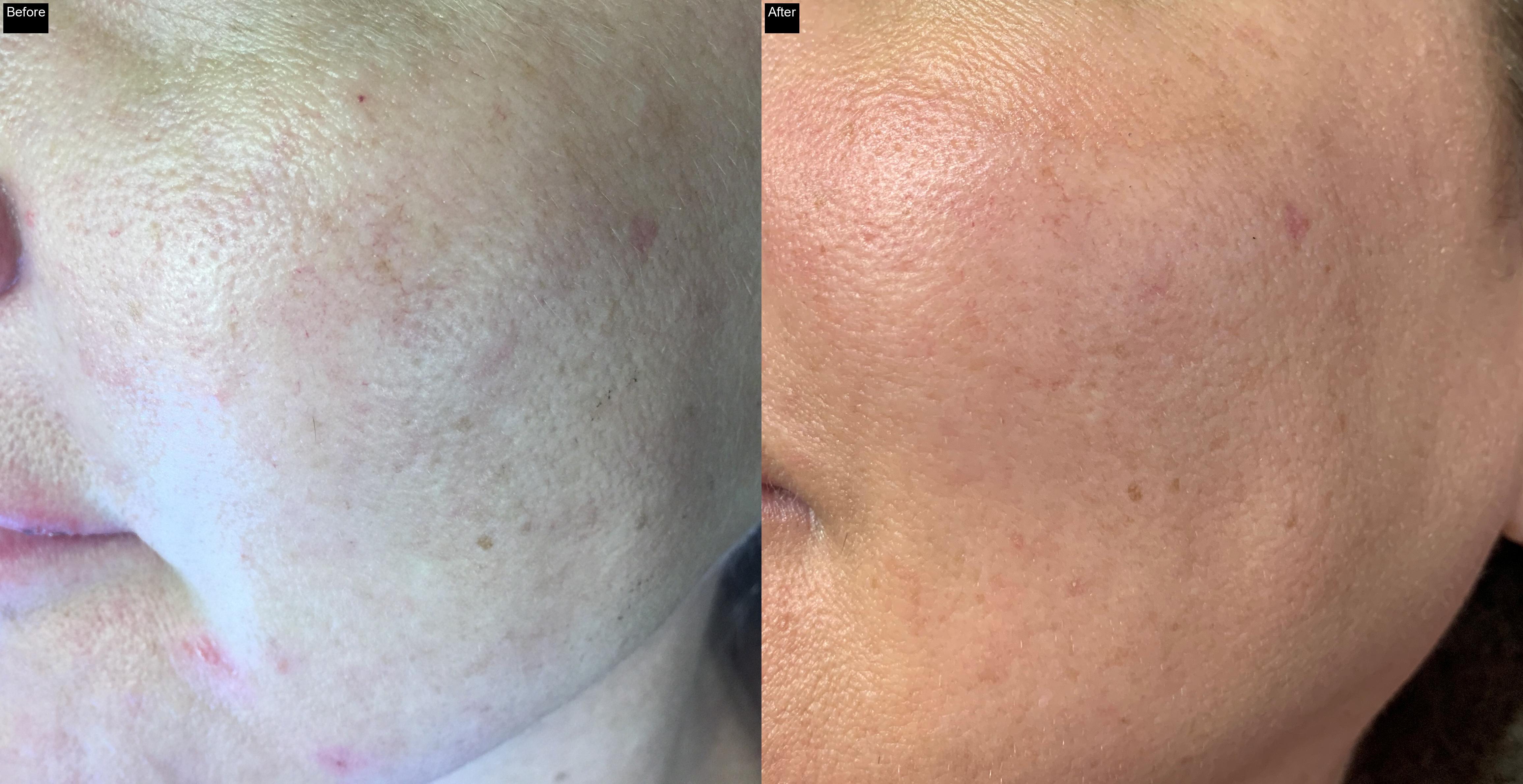 Before / After : Acne Scar Removal with IPL in Javea -2