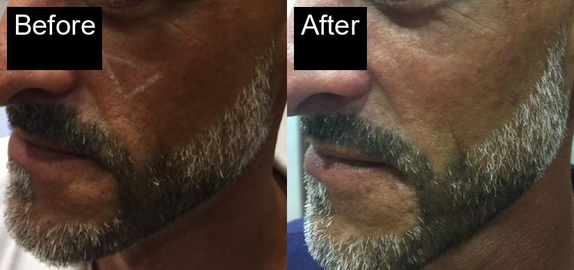 Before / After : Aesthetic Treatments for Men in Javea – Look Strong, Confident, and Youthful -2