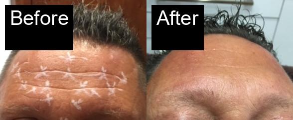 Before / After : Aesthetic Treatments for Men in Javea – Look Strong, Confident, and Youthful -3