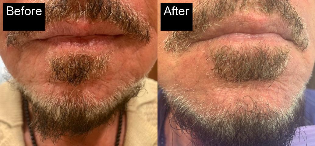 Before / After : Aesthetic Treatments for Men in Javea – Look Strong, Confident, and Youthful -4