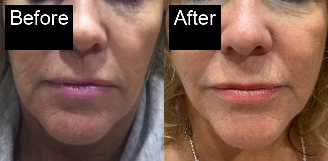 Before / After : Aptos Threadlift in Javea – Non-Surgical Skin Tightening -1