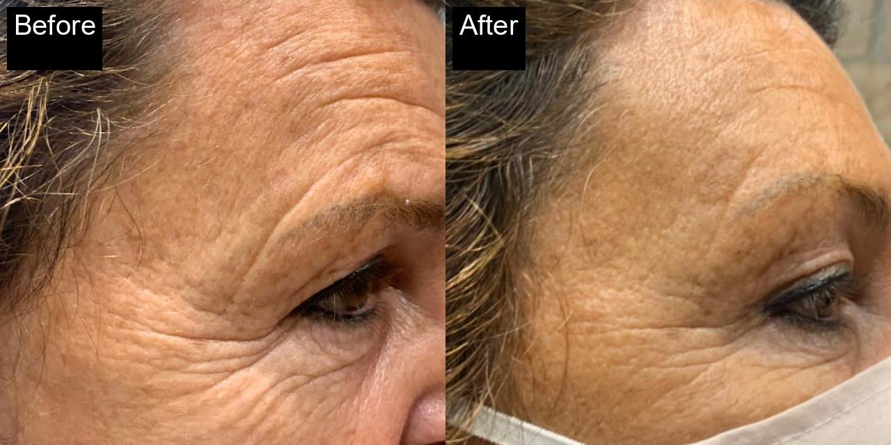 Before / After : Aptos Threadlift in Javea – Non-Surgical Skin Tightening -3