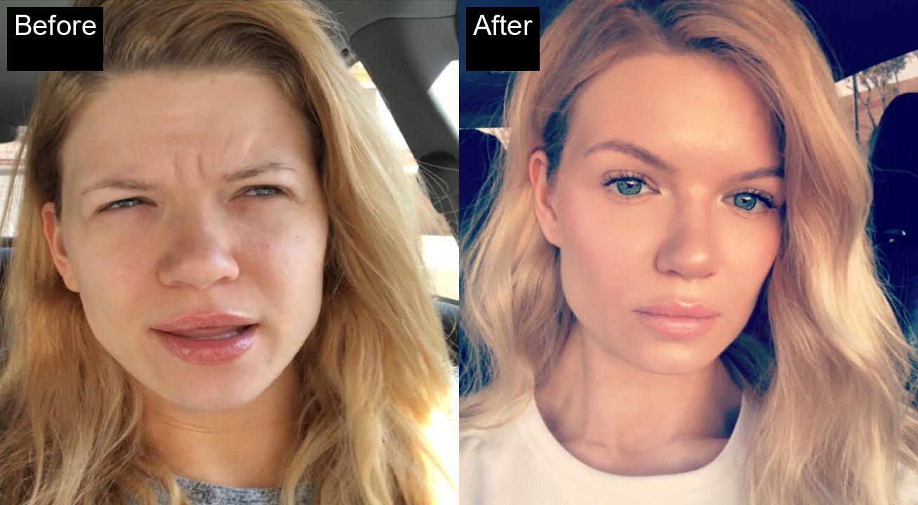 Before / After : Botox Treatments in Javea - Expert Anti-Aging Solutions -1