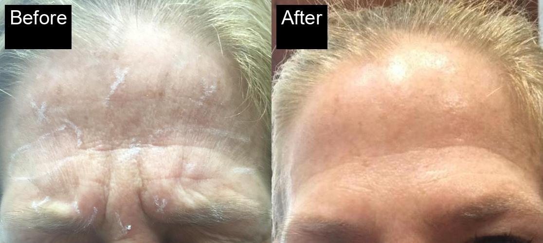 Before / After : Botox Treatments in Javea - Expert Anti-Aging Solutions -10