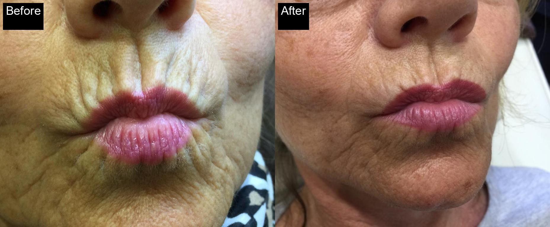 Before / After : Botox Treatments in Javea - Expert Anti-Aging Solutions -11