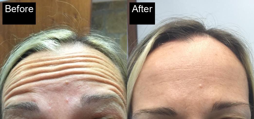 Before / After : Botox Treatments in Javea - Expert Anti-Aging Solutions -12