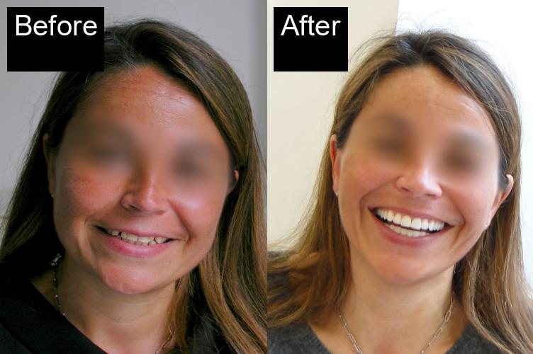 Before / After : Botox Treatments in Javea - Expert Anti-Aging Solutions -4