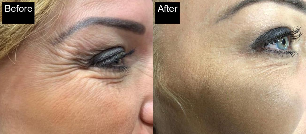 Before / After : Botox Treatments in Javea - Expert Anti-Aging Solutions -6