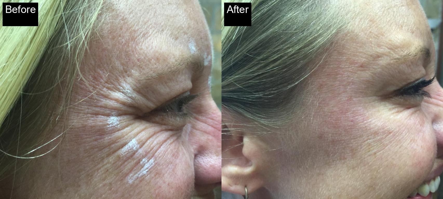 Before / After : Botox Treatments in Javea - Expert Anti-Aging Solutions -7
