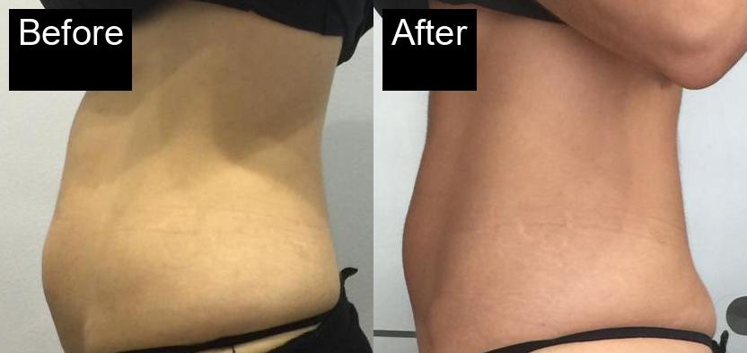 Before / After : Cryolipolysis in Javea With Spa Javea -1