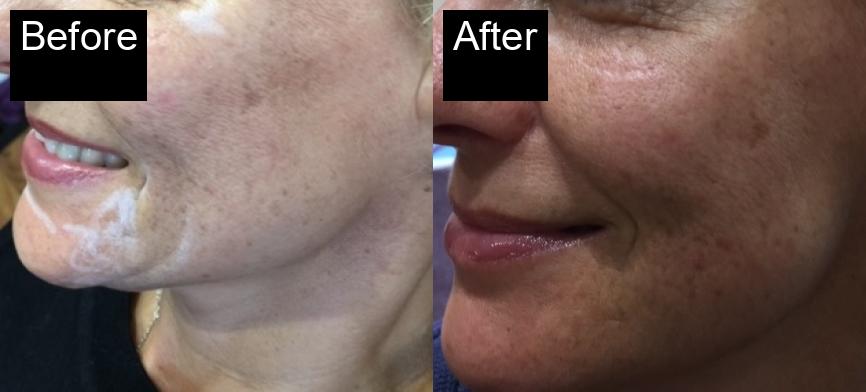 Before / After : Facial Rejuvenation in Javea – Achieve Youthful, Glowing Skin -1