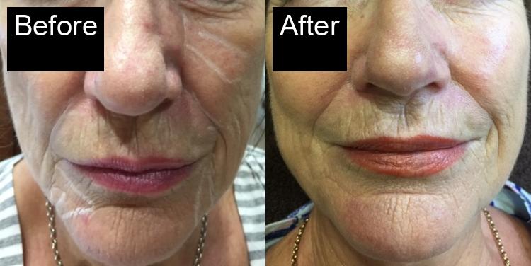 Before / After : Fillers Treatments in Javea – Restore Youthful Skin & Volume -10