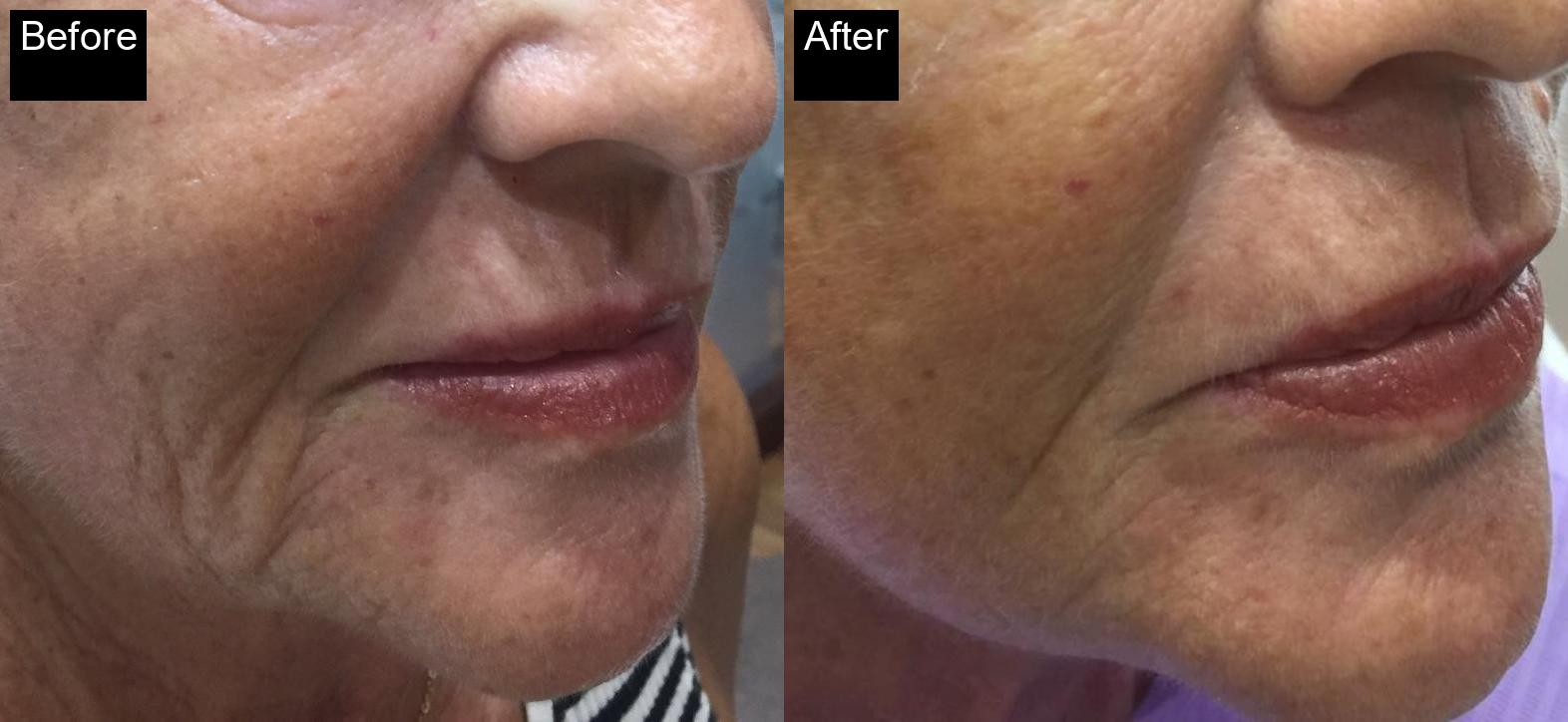 Before / After : Fillers Treatments in Javea – Restore Youthful Skin & Volume -11