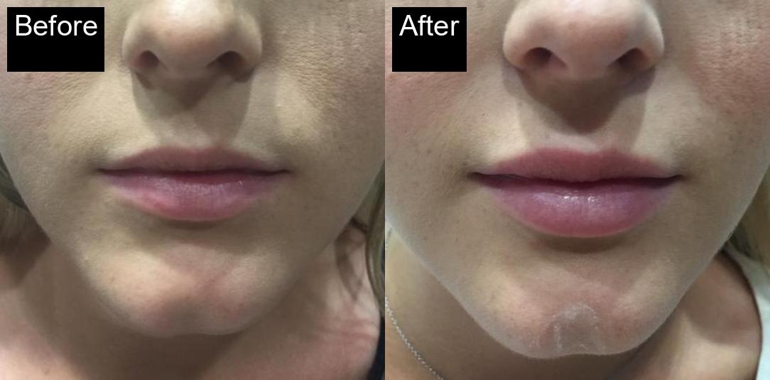Before / After : Fillers Treatments in Javea – Restore Youthful Skin & Volume -2
