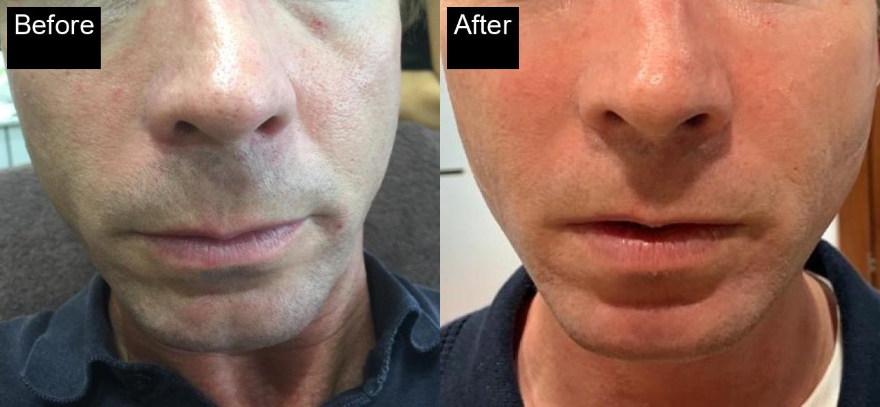 Before / After : Fillers Treatments in Javea – Restore Youthful Skin & Volume -4