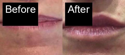Before / After : Fillers Treatments in Javea – Restore Youthful Skin & Volume -6