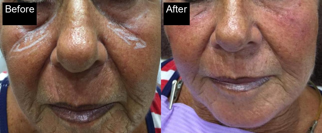 Before / After : Fillers Treatments in Javea – Restore Youthful Skin & Volume -8