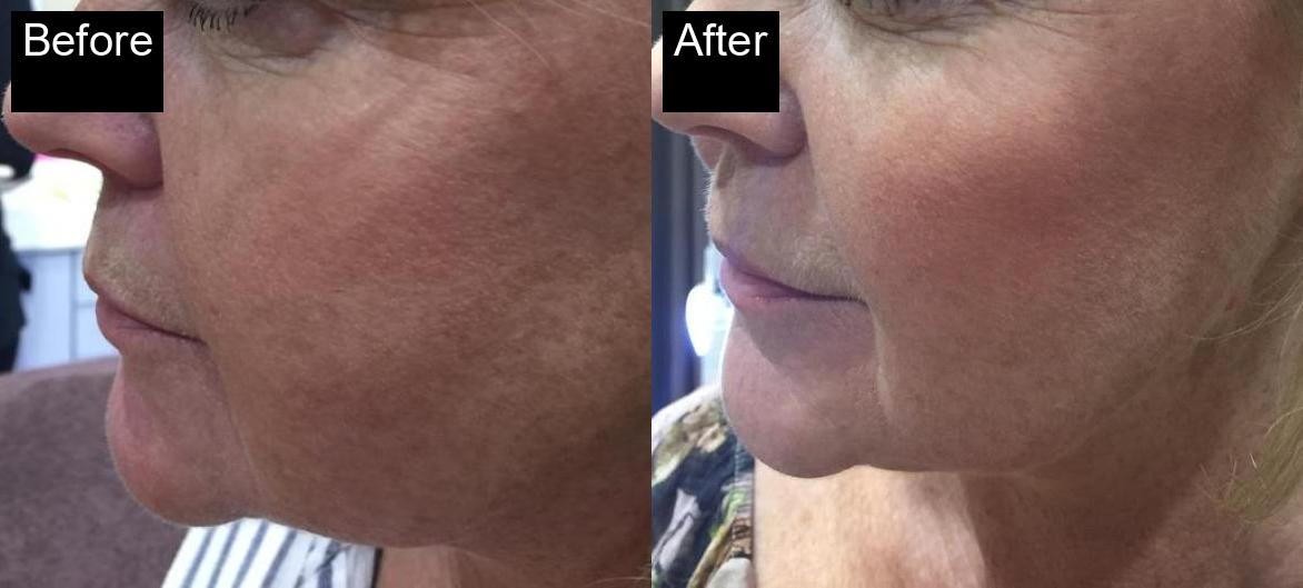 Before / After : Fillers Treatments in Javea – Restore Youthful Skin & Volume -9