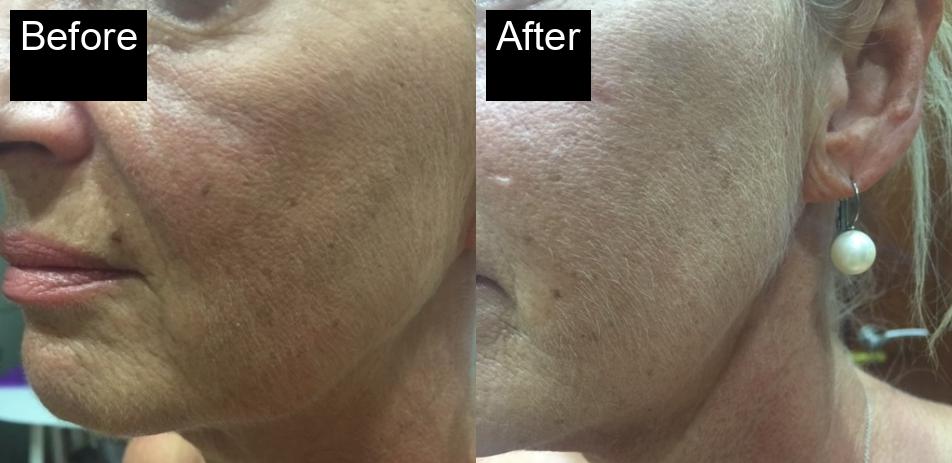 Before / After : HIFU Non-Surgical Facelift in Javea – Smooth and Tighten Your Skin -3