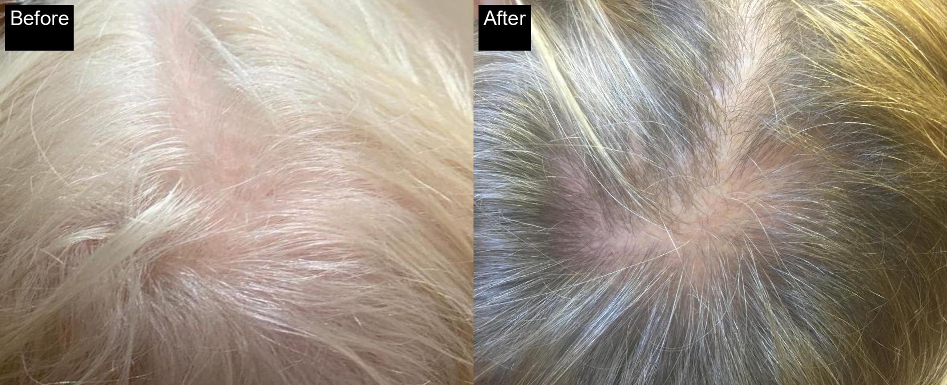 Before / After : Mesotherapy & Microneedling in Javea – Advanced Anti-Aging Treatments -1