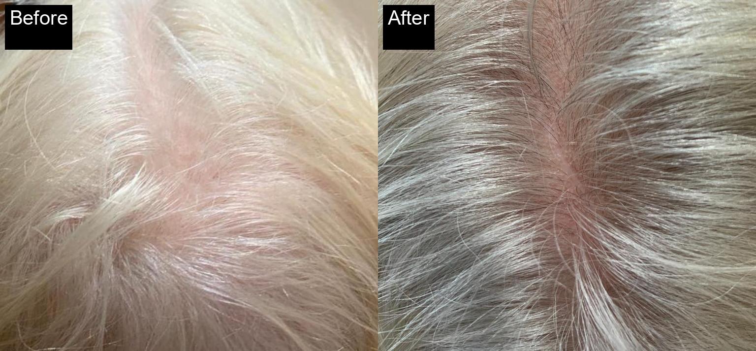 Before / After : Mesotherapy & Microneedling in Javea – Advanced Anti-Aging Treatments -2