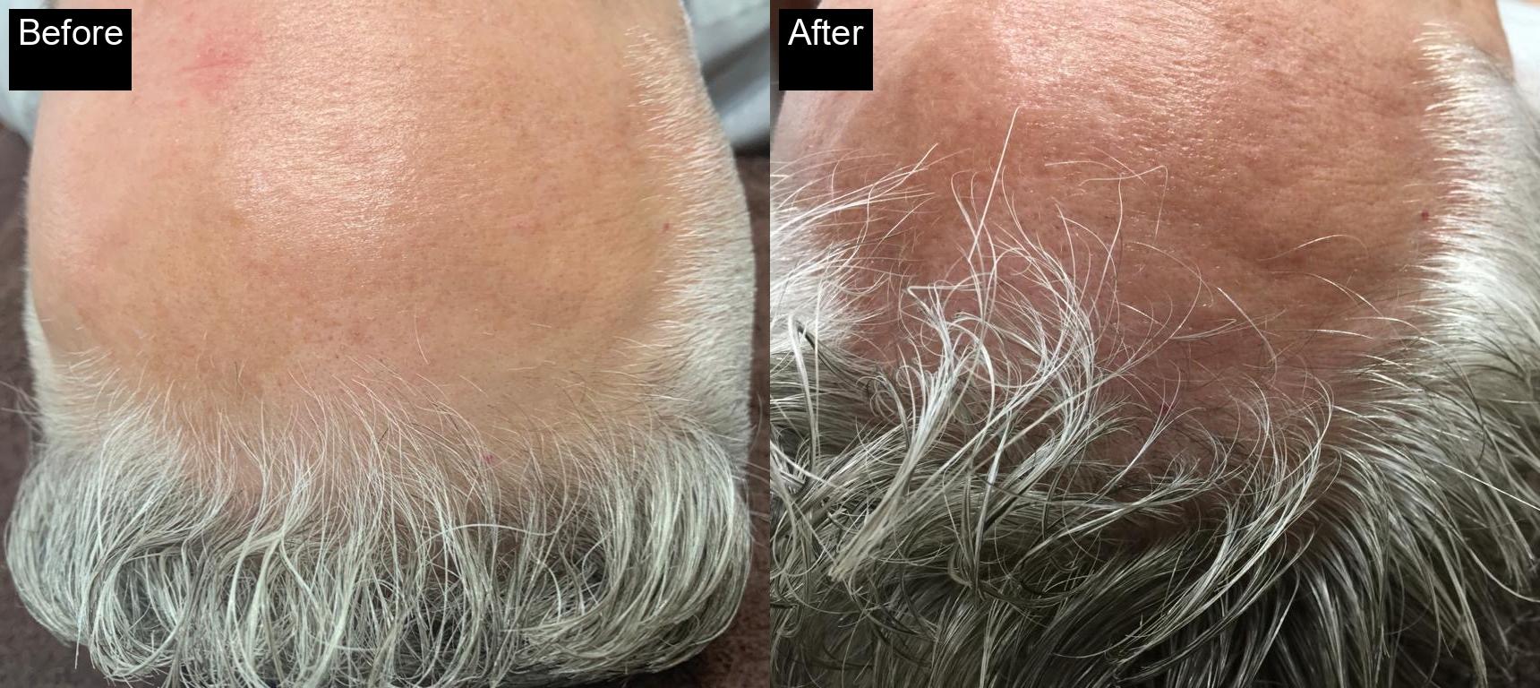 Before / After : Mesotherapy & Microneedling in Javea – Advanced Anti-Aging Treatments -4