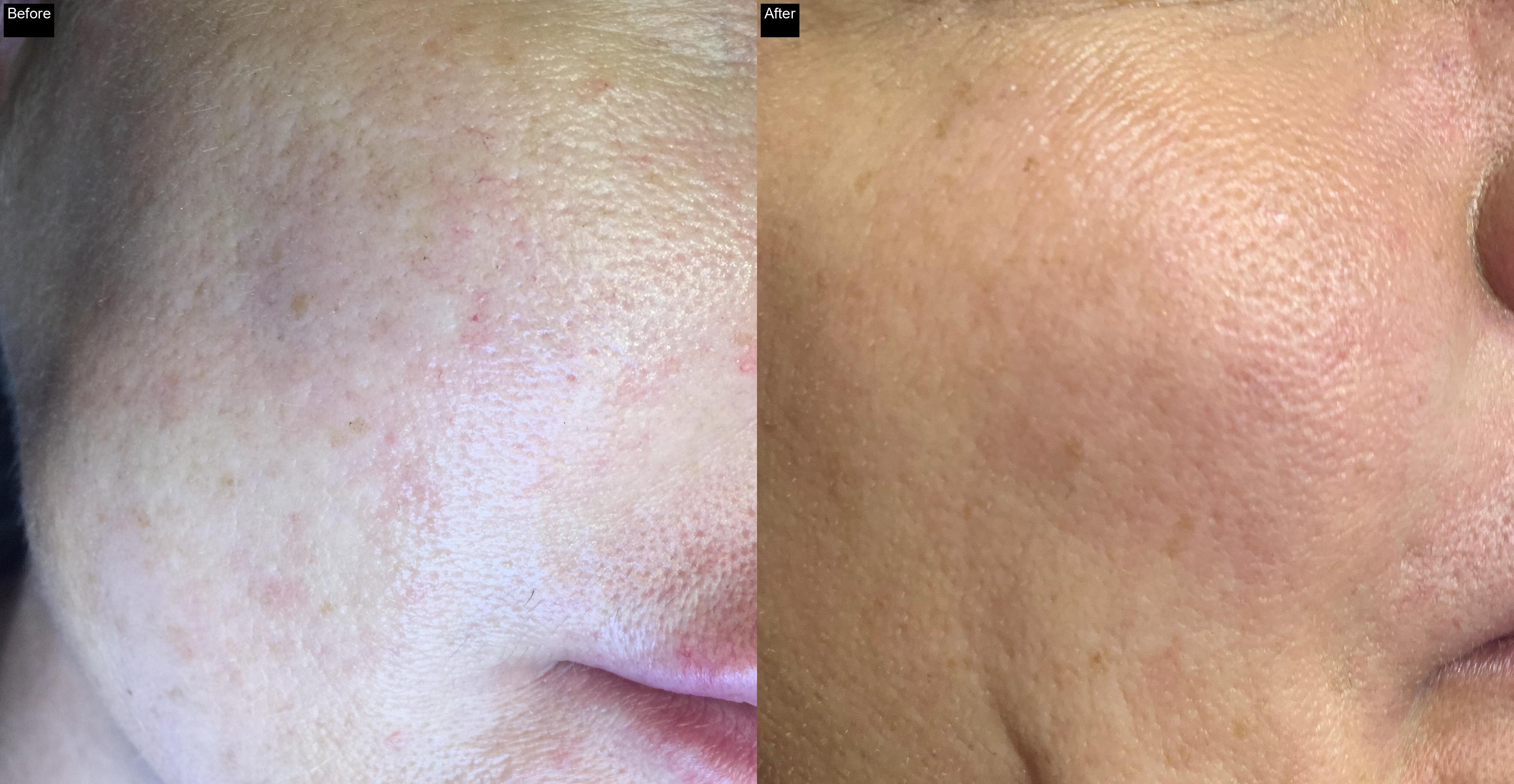 Before / After : Mesotherapy & Microneedling in Javea – Advanced Anti-Aging Treatments -5