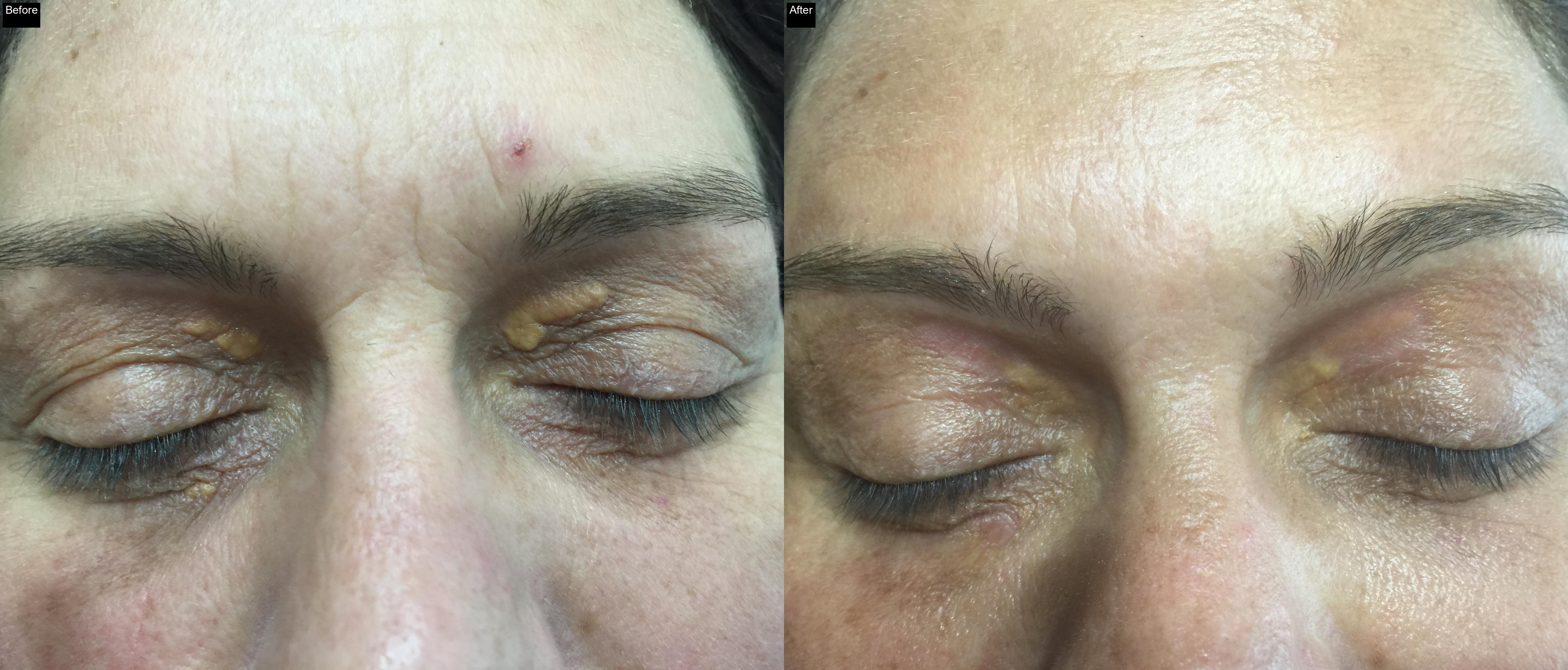 Before / After : Peels in Javea : Revitalize Your Skin with Chemical Peels in Javea -3