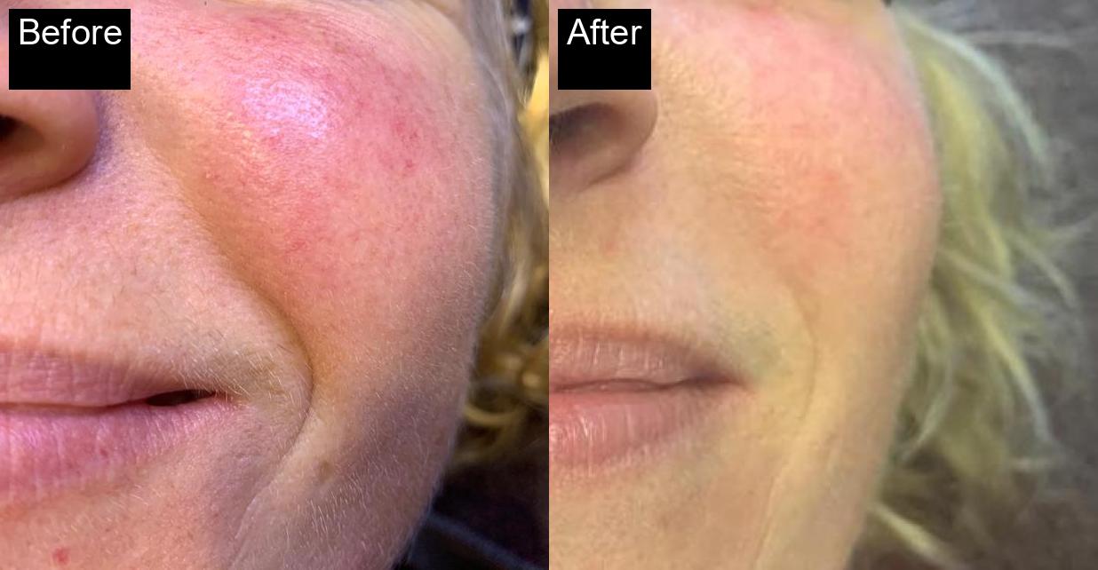 Before / After : Professional Mole & Wart Removal in Javea – Safe & Effective Treatments -1