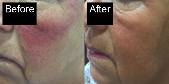 Before / After : Professional Mole & Wart Removal in Javea – Safe & Effective Treatments -2