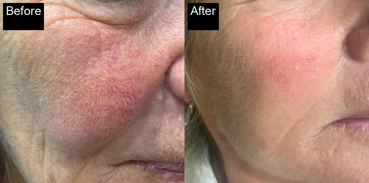 Before / After : Professional Mole & Wart Removal in Javea – Safe & Effective Treatments -3