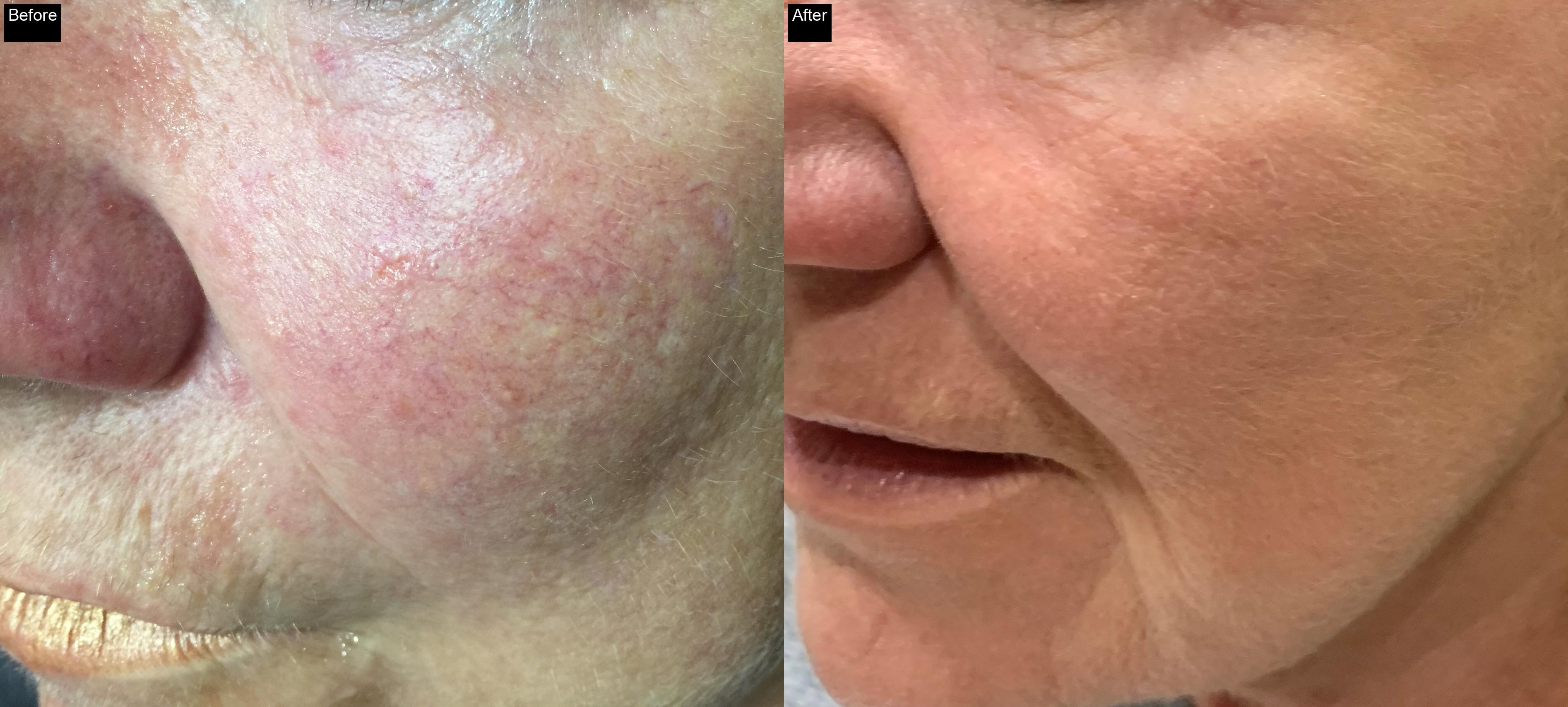 Before / After : Professional Mole & Wart Removal in Javea – Safe & Effective Treatments -4