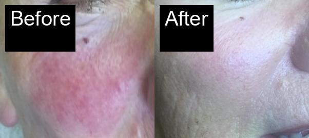 Before / After : Professional Mole & Wart Removal in Javea – Safe & Effective Treatments -5