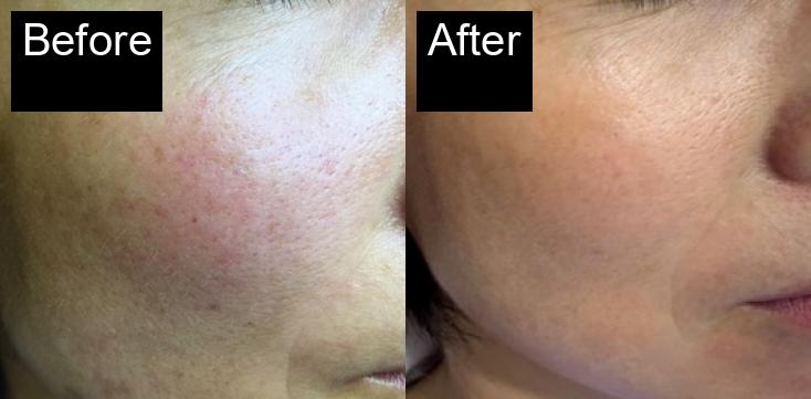 Before / After : Professional Mole & Wart Removal in Javea – Safe & Effective Treatments -6